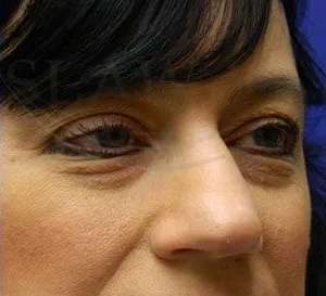 Liquid Rhinoplasty Before & After Patient #767