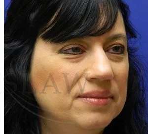 Liquid Rhinoplasty Before & After Patient #767
