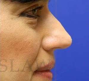 Liquid Rhinoplasty Before & After Patient #767