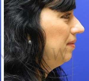 Liquid Rhinoplasty Before & After Patient #767