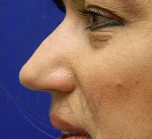 Liquid Rhinoplasty Before & After Patient #767