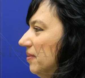 Liquid Rhinoplasty Before & After Patient #767