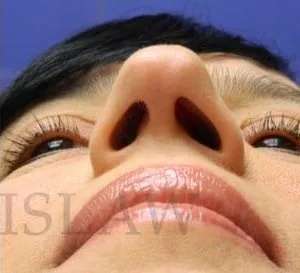 Liquid Rhinoplasty Before & After Patient #767