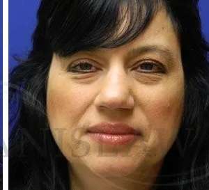 Liquid Rhinoplasty Before & After Patient #767