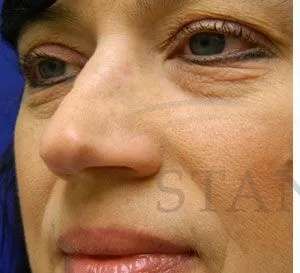 Liquid Rhinoplasty Before & After Patient #767
