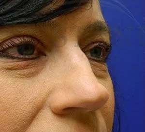 Liquid Rhinoplasty Before & After Patient #767