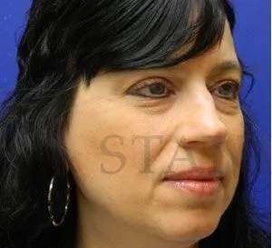 Liquid Rhinoplasty Before & After Patient #767