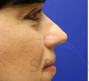 Liquid Rhinoplasty Before & After Patient #767