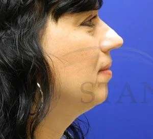 Liquid Rhinoplasty Before & After Patient #767