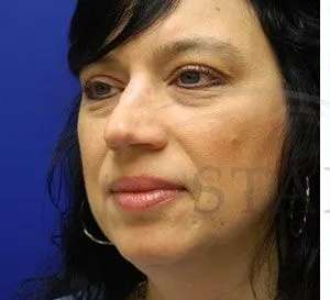 Liquid Rhinoplasty Before & After Patient #767