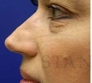 Liquid Rhinoplasty Before & After Patient #767