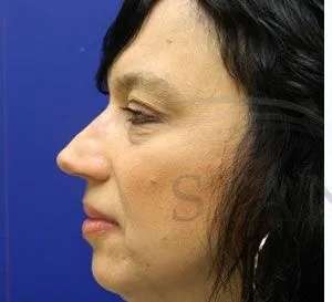 Liquid Rhinoplasty Before & After Patient #767