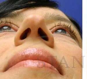 Liquid Rhinoplasty Before & After Patient #767
