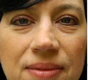 Liquid Rhinoplasty Before & After Patient #767