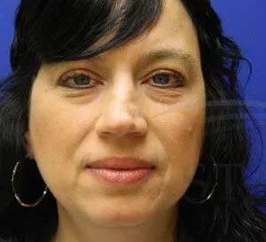 Liquid Rhinoplasty Before & After Patient #767
