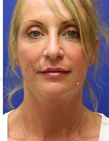 Liquid Rhinoplasty Before & After Patient #793