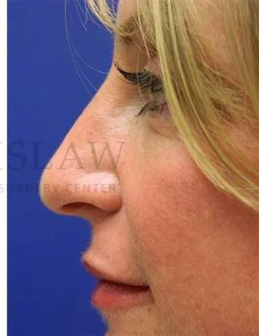 Liquid Rhinoplasty Before & After Patient #793