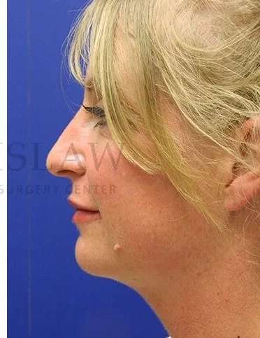 Liquid Rhinoplasty Before & After Patient #793
