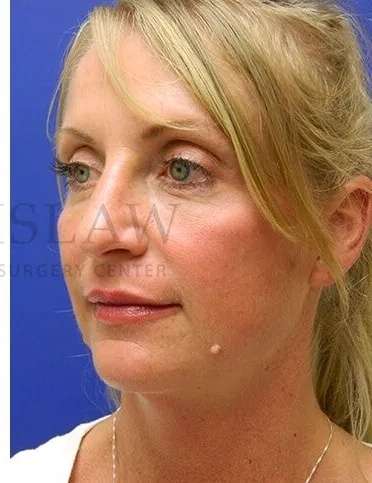 Liquid Rhinoplasty Before & After Patient #793