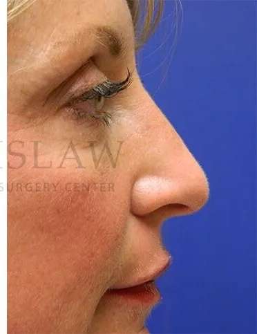 Liquid Rhinoplasty Before & After Patient #793