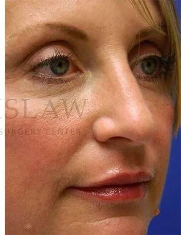 Liquid Rhinoplasty Before & After Patient #793