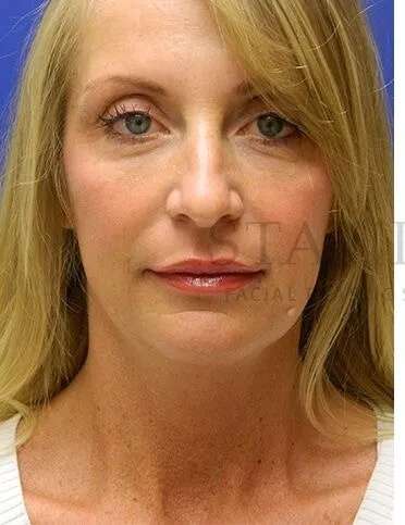 Liquid Rhinoplasty Before & After Patient #793