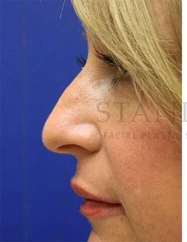 Liquid Rhinoplasty Before & After Patient #793