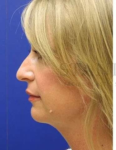 Liquid Rhinoplasty Before & After Patient #793