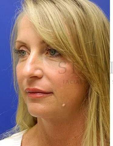 Liquid Rhinoplasty Before & After Patient #793