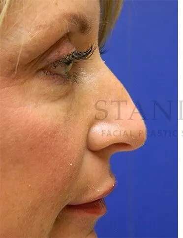 Liquid Rhinoplasty Before & After Patient #793