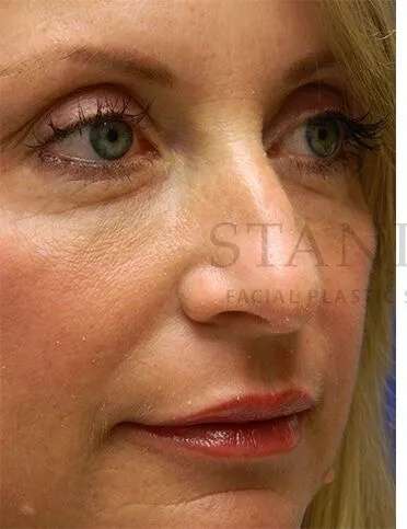 Liquid Rhinoplasty Before & After Patient #793