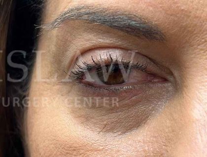 Lower Blepharoplasty Before & After Patient #804