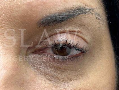 Lower Blepharoplasty Before & After Patient #804