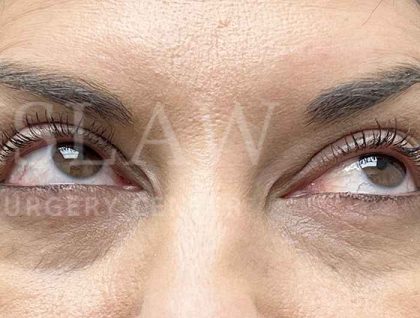 Lower Blepharoplasty Before & After Patient #804