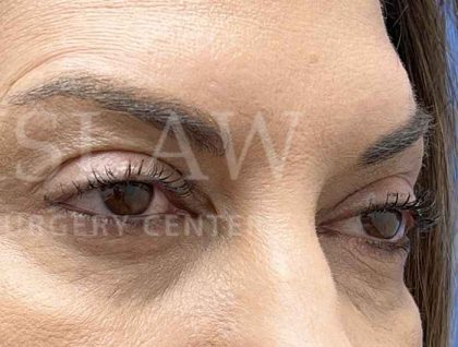 Lower Blepharoplasty Before & After Patient #804