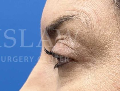 Lower Blepharoplasty Before & After Patient #804