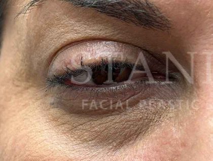 Lower Blepharoplasty Before & After Patient #804