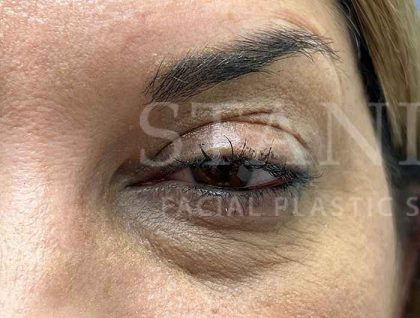 Lower Blepharoplasty Before & After Patient #804