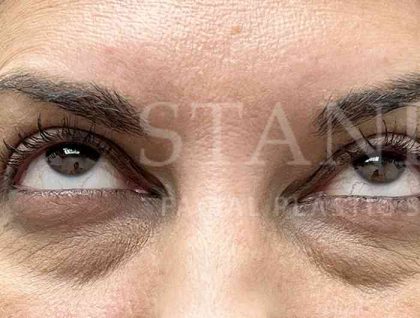 Lower Blepharoplasty Before & After Patient #804
