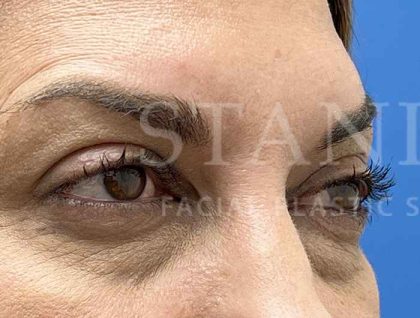 Lower Blepharoplasty Before & After Patient #804
