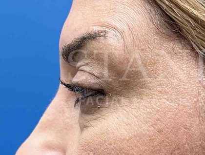 Lower Blepharoplasty Before & After Patient #804