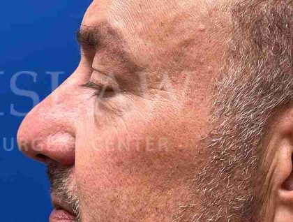 Lower Blepharoplasty Before & After Patient #828