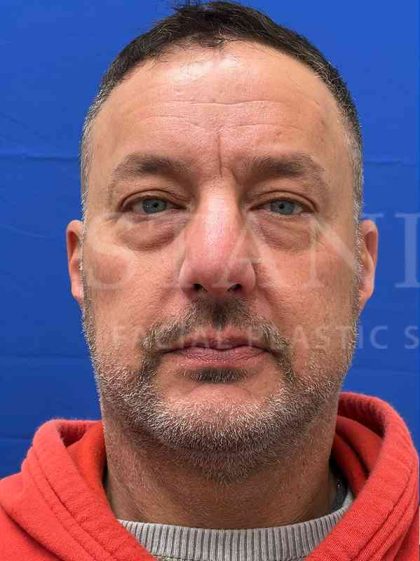 Lower Blepharoplasty Before & After Patient #828