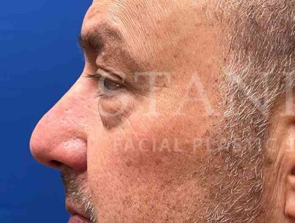Lower Blepharoplasty Before & After Patient #828