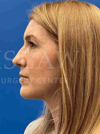 Lower Blepharoplasty Before & After Patient #821