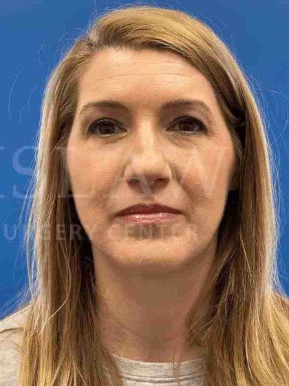 Lower Blepharoplasty Before & After Patient #821