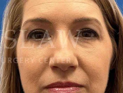 Lower Blepharoplasty Before & After Patient #821