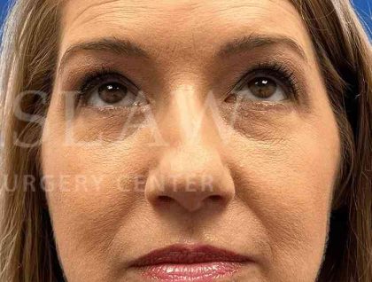 Lower Blepharoplasty Before & After Patient #821