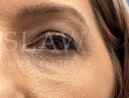 Lower Blepharoplasty Before & After Patient #821
