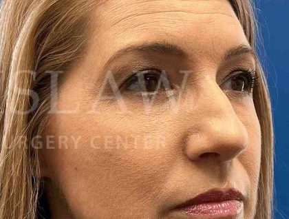 Lower Blepharoplasty Before & After Patient #821